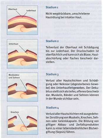 bilder stadien des dekubitus