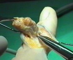 Operation am Riesenzelltumor