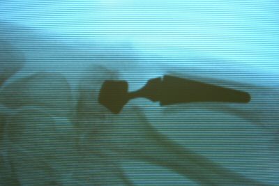 implantierte sattelgelenkprothese im röntgenbild bild gross