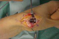 Implantiertes Gelenk in Funktionsstellung